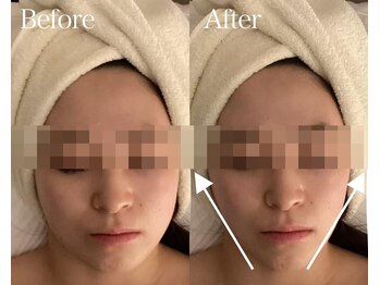 ベル 後楽園 春日(Belle)/小顔/リフトアップ/二重顎