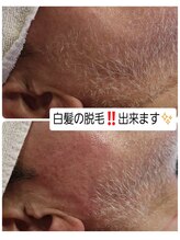 ベビースキン(baby skin)/美容電気脱毛