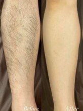 クーレ(CURE)/脚脱毛ビフォーアフター