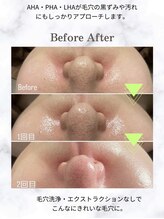 リノア 堀江(Linoa)/毛穴洗浄＆水光肌ピーリング