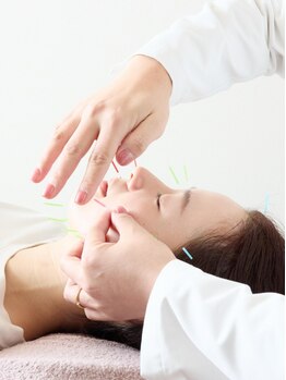 インヤン(yinyang)の写真/そのほうれい線、まだ放置しますか？yinyangの美容鍼なら30、40、50代以降の深いほうれい線にもアプローチ!