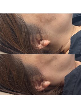 ミィ(mi)の写真/自己処理が難しいおでこの産毛や、もみあげの産毛もナチュラルにWAXで整えることができます☆