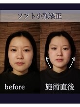 ヘッドラボ(Headlabo★3103)/ソフト小顔矯正