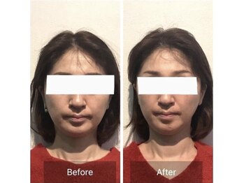 ハリナチュレ 神戸元町店/小顔美容鍼 Before After