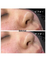 ブライズ(BRISE)/W幹細胞フェイシャル