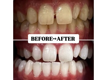 ホワイトニングサロン 豊中/Before&After美白ホワイトニング