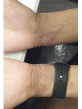 エミリー 守山(EMILY)/【症例写真】プラズマミスト (3)