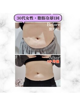 グランディールアン(GRANDIR UN)/脂肪冷却1回！