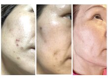 CBDサロン ローズ(ROSE)の雰囲気（シミ比較写真。根本的改善と肌育成を目指します）