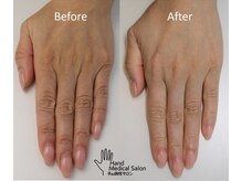 ミーレ(Miele)/一度のトリートメントでも実感