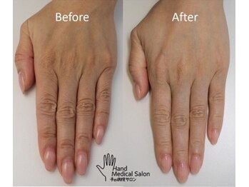 ミーレ(Miele)/一度のトリートメントでも実感