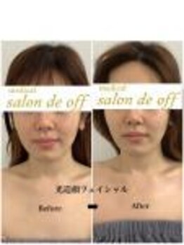 メディカルサロンドオフ 堺東店(medical salon de off)/光造顔フェイシャル★ &nbsp;施術前後