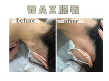 レヴィート(Revept)/【ワックス脱毛】