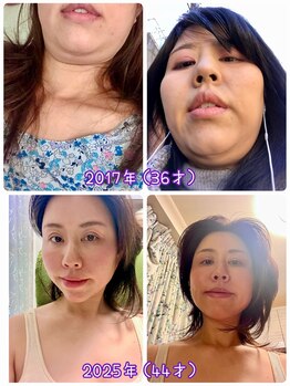 サロン ド ピラティス ラワンデル(salon de pilates)/小顔エステビフォーアフター