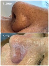 モテ 新宿店(Mote)/毛穴洗浄＋艶肌Wax 新宿 新宿