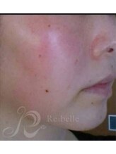 リン 長崎 大村(Rin)/after