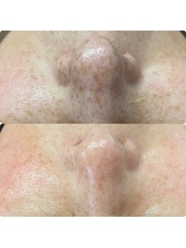 オーノ(Ohno)/【シミ改善】マツヤニ×クレイ