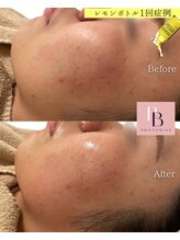 フォトビズ/二重顎もたつき顔たるみ改善