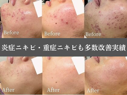 ニキビ研究所 千葉店の写真