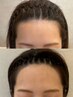 【spk】生え際全体