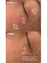 ニコ(nico)/目尻の皺、赤み対策！