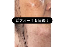 ソライロの雰囲気（シミが瘡蓋みたいになり綺麗に！ソライロ脱毛でシミケアも♪）