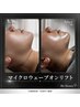 【人気No.1】二重あご・たるみが気になる方へ◎横顔に自信が持てるラインへ
