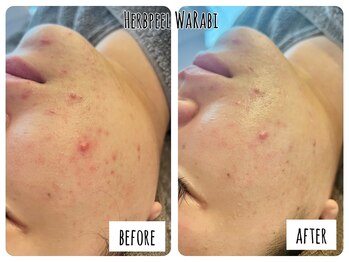 ハオン(HAON)/ハーブピーリング/ニキビ/毛穴