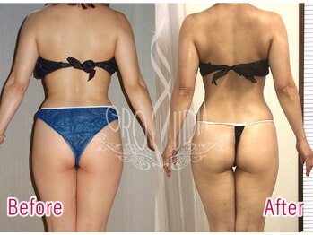 グラウディア 恵比寿/痩身/筋膜リリース/インディバ超