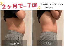 ケービューティー 小顔(K-beauty)/キャビテーション＋ラジオ波