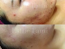 エステ ラミ(Esthe' l'ami)/ニキビにお悩みの方へ