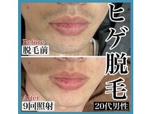 ツバキ(TSUBAKI)/ヒゲ脱毛