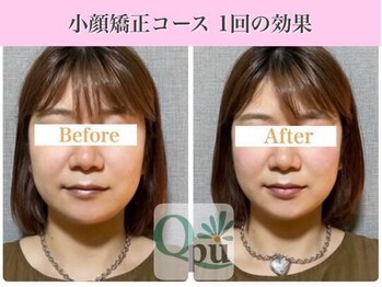 キュープ 福岡大牟田店(Qpu)/小顔矯正コース1回の変化