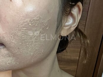 グリーンピール エルモナ(GREENPEEL ELMONA)/【グリーンピール5Days】シェド