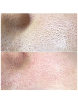 プアラ(puala)/頬もスッキリ