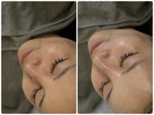 シード(SHE°)/REVI陶肌トリートメント