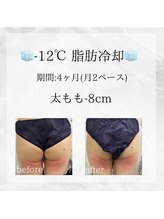 メディカルエステ 恵比寿店/＊脂肪冷却 太もも症例＊