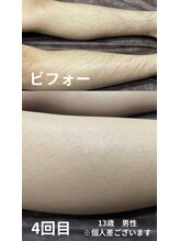 ブランコ バイ ボンド(BLANCO By BOND)/キッズ脱毛4回目