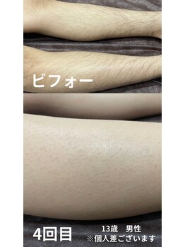 ブランコ バイ ボンド(BLANCO By BOND)/キッズ脱毛4回目