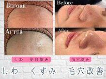 ブランリス 京都店(Blanclis)の雰囲気（REVIハーブピーリングはニキビだけじゃない！しわ毛穴にも効果有）