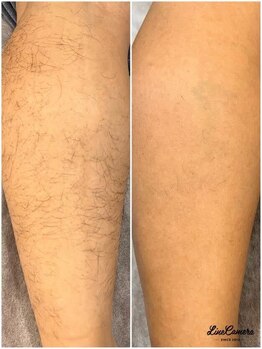 ヒーリングリゾート ナゴミ(Nagomi)/メンズ脱毛