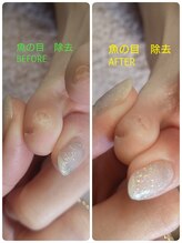 フットスタジオ アルク(FOOT STUDIO ALUK)/【小指の間の魚の目除去ケア】