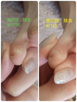 フットスタジオ アルク(FOOT STUDIO ALUK)/【小指の間の魚の目除去ケア】