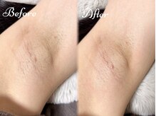 ピミル(PIMIL)/ワキ脱毛