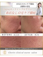 シェリー(Cherie)/施術なし！ニキビ後の凹凸改善