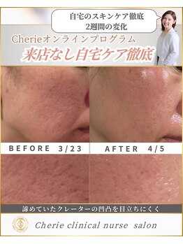 シェリー(Cherie)/施術なし！ニキビ後の凹凸改善