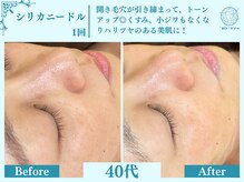 フローフシ∞/【医療機関監修】開き毛穴改善