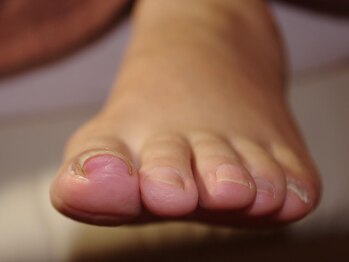 ピュアフット仙台駅前店/巻爪の主な原因【2】⇒