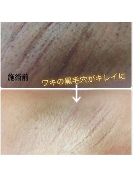 ラウレア 松山店(LAULEA)/毛穴レス美肌ワキ脱毛