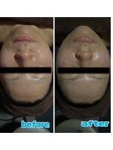 ラクラク(rakuraku)/リフトアップフェイシャル20代女